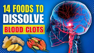 14 Foods That Dissolve Blood Clots NATURALLY (Doctors WON'T Tell You!)