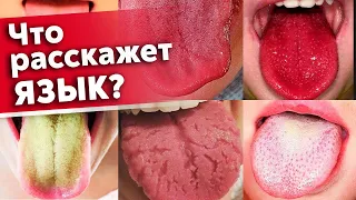 Язык предупредит вас о болезнях! | Как диагностировать состояние организма по языку?