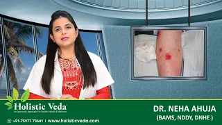 वैरिकोज वेन्स - लक्षण एवं कारण | सर्जरी नहीं हैं अंतिम उपाय || Varicose Veins - Symptoms and Causes