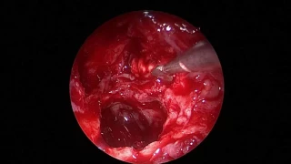 Optic nerve decompression in Revision FESS ( Video 4 ) - Dr. Satish Jain - www.skullbase360.in