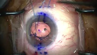 modified canabrava using toric IOL