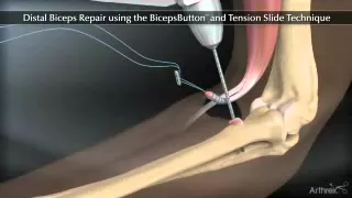Distal Biceps Repair Animation