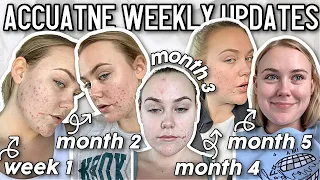 My Accutane Journey: *Weekly Updates,* Side Effects, & Post Accutane Update