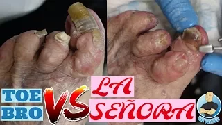 HAMMERTOE CUTTING THICK LONG RAM'S HORN HAMMER TOE TOENAILS - EN ESPAÑOL?!?! (TURN ON ENGLISH CC)