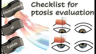 Checklist for ptosis evaluation