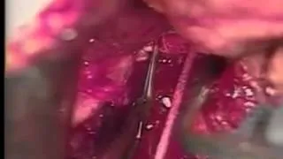 End to side portocaval anastomosis for portal hypertension and bleeding varices