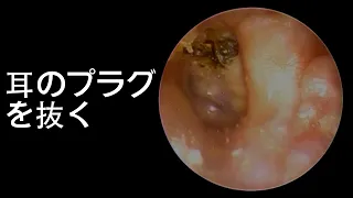 Relaxing Earwax Removal: unplug the plug in the ear