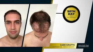 Hair Transplant Turkey Before  & After - 8 Months Results