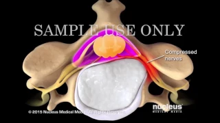 005  Neck Surgery   Cervical Discectomy   Nucleus Health