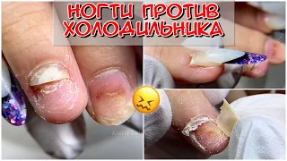 Ногти против холодильника / Сломала ногти / Уронила на пальцы холодильник / Онихолизис / Отслойки