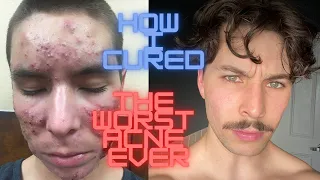 how I cured the worst acne EVER | routine + best tips