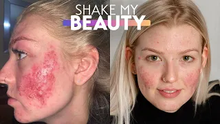 My Cystic Acne Is So Bad It Went Viral | SHAKE MY BEAUTY