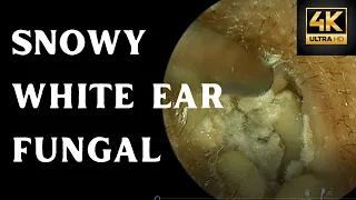 Severe Hearing Loss Due To White Creamy Ear Fungus (4K 60FPS)