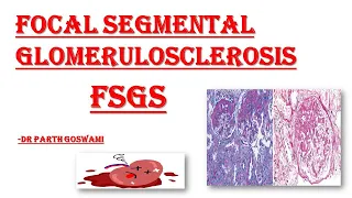 FSGS | Focal Segmental Glomerulosclerosis | Type of Nephrotic Syndrome | Made easy