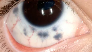 Pigmented Conjunctival Lesions  Dr  Ralph Eagle