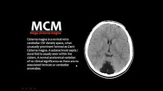 Special Types of Hydrocephalus by Prof. Mamdouh Mahfouz. Organized by Dr. Ramy  El-Sherbini19-3-2019