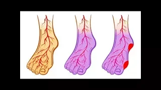Если у Вас Высокое Давление Или Варикоз, Начните Делать Это