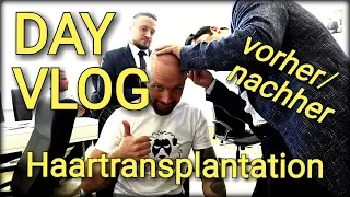 Vorher Nachher Haartransplantation Istanbul - DAY VLOG
