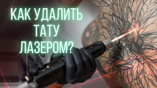 Как удалить тату лазером? Баски о тату