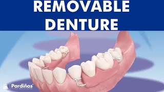 Removable partial denture ©