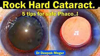 Rock Hard Cataract-Strategies for safe Phaco - Dr Deepak Megur