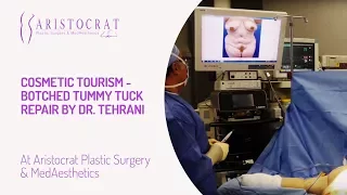 Cosmetic Tourism - Botched Tummy Tuck Repair by Dr. Tehrani