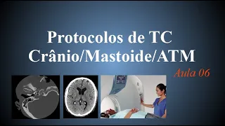Curso de tomografia - Aula 6 (Protocolos Crânio, Mastoide, ATM)