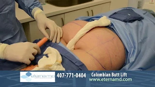 Colombian Butt Lift with Liposculpture | Eterna MD Medical Rejuvenation Center | Orlando, FL