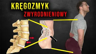 Ból kręgosłupa lędźwiowego |  KRĘGOZMYK a hiperlordoza