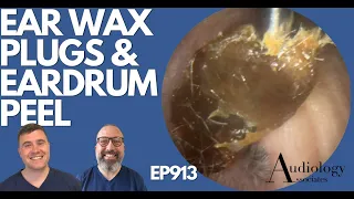 EAR WAX PLUGS & EARDRUM PEEL - EP913