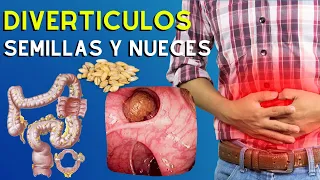 🥜 ¿Las Semillas y Nueces Producen Diverticulitis en el Colon? Evidencia Científica y Análisis