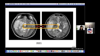 AMIQT : Dr Li Qin, Mitochondrial Encephalitis