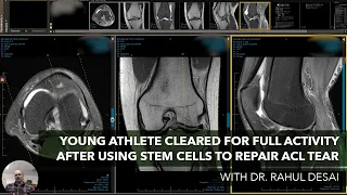 Young Athlete Cleared for Full Activity after Using Cell Therapy to Repair ACL Tear