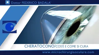 Cheratocono: Cos'è e Novità sulla cura