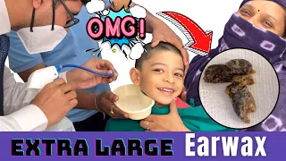 How to remove hard wax from small children | बिना दर्द के केसे निकला इतना सारा मेल | Video otoscaopy