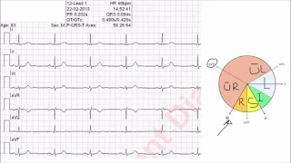 Bestimmung des Lagetyps (vereinfachte Methode mit Tabelle oder Cabrera Kreis)