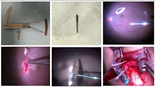 Vitrectomy for IOFB | Intraocular foreign body removal | Dr Manish Nagpal