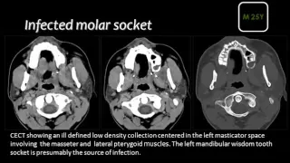 Imaging of Head and Neck Infections I   DRE 17   Dr  Mamadouh Mahfouz