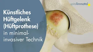 Künstliches Hüftgelenk (Hüftprothese) - Hüftgelenkersatz in minimal-invasiver Technik