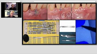 Terapia endodontica e restauro post endodontico: una consecutio procedurale - Parte 2