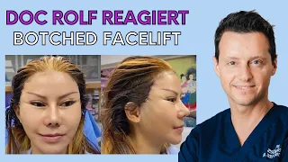 Botched FACELIFT VORHER NACHHER – Dr. Rolf Bartsch reagiert