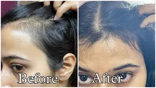 Best Hair Serums For Reduced Hair fall and Hair Growth