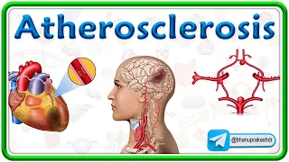 Atherosclerosis Pathology Animation: Causes, Pathogenesis, Risk factors, Complications: USMLE Step 1