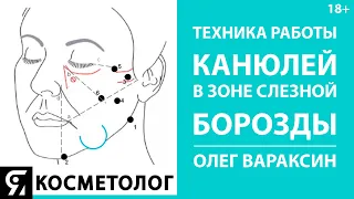 Техника работы канюлей в зоне слезной борозды Олег Вараксин врач косметолог, дерматовенеролог