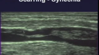 Sonographic Evaluation of Lower Extremity Venous Disease