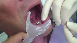 Locator Attachment Pickup (Implant Overdenture) - Dr. Dray