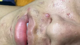 Acne Treament Under The Skin #050