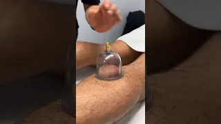 Foot Cupping For Runners!