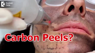 All about Carbon Laser Peels or Hollywood Peels - Dr. Sankeerth Vijayakumar