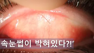 속눈썹이 박혀있다?! ectopic cilia?